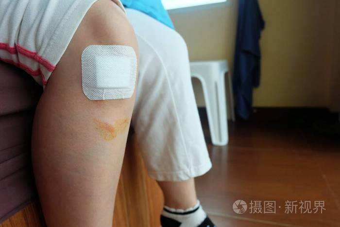 膝盖上的石膏闭合伤.从事故患者