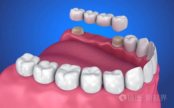 牙支承固定桥.医学上精确的3d 例证
