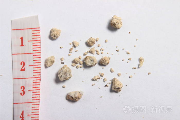 平躺或顶部视图非常小肾结石在白色背景下