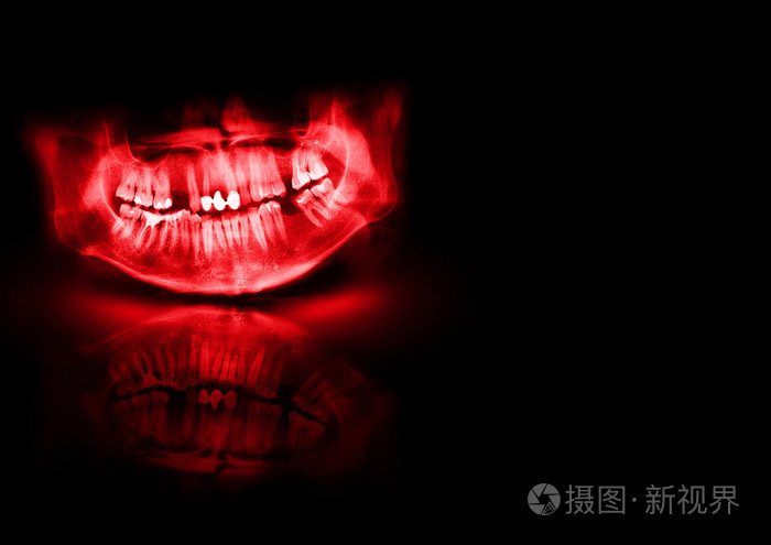 黑色和红色的x射线的牙齿扫描下颌骨