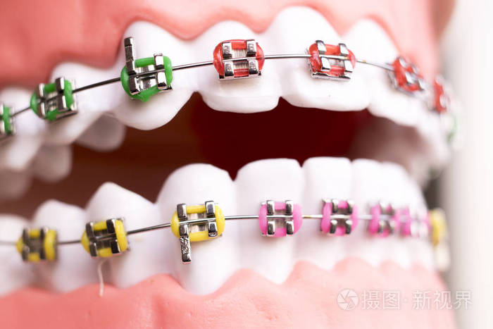 牙科金属牙直线对准器固定器的教学正畸模型