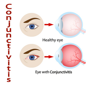 结膜炎眼病毒视力虹膜眼科结膜炎