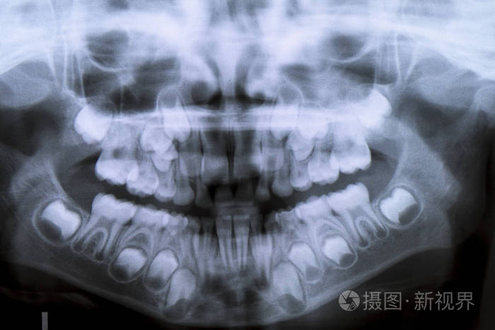 全景牙科 x 射线八岁儿童的问题不松动他的乳牙-持续乳牙