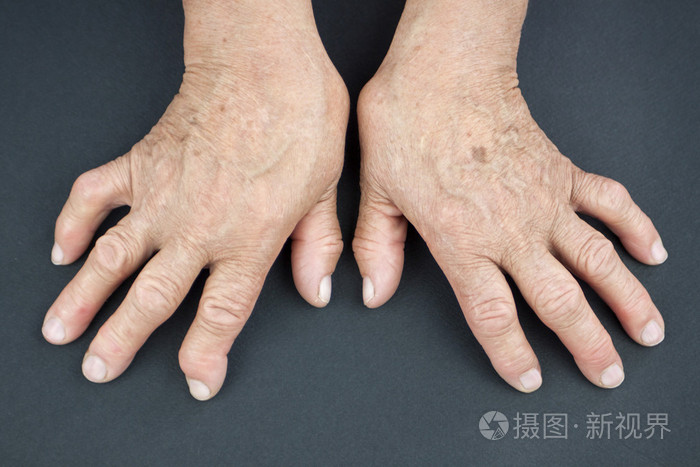 类风湿关节炎从变形的女人的手照片-正版商用图片06uv0d-摄图新视界