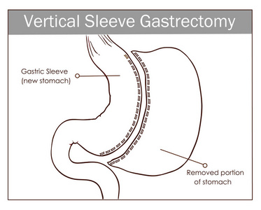 矢量图胃垂直袖状切除