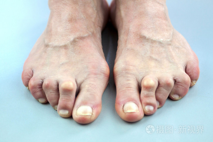 变形从类风湿关节炎的女人的脚