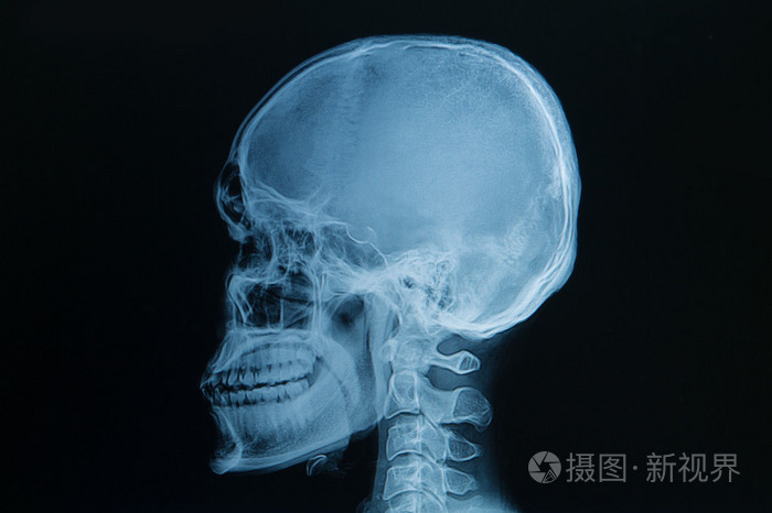 颅骨x 光片图像