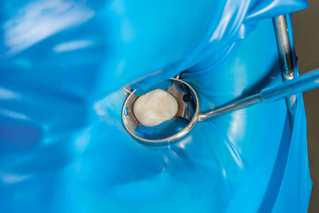 人牙龋病的治疗。用复合材料修复牙齿牙齿的概