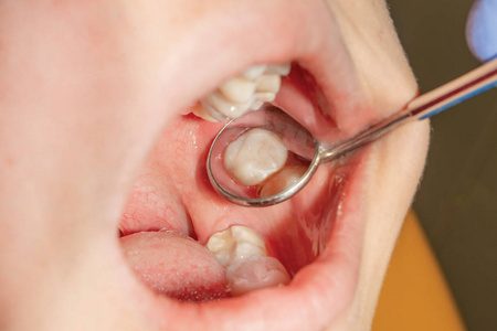 用填充材料修复人牙的磨牙。牙科诊所美容修复牙科的概念
