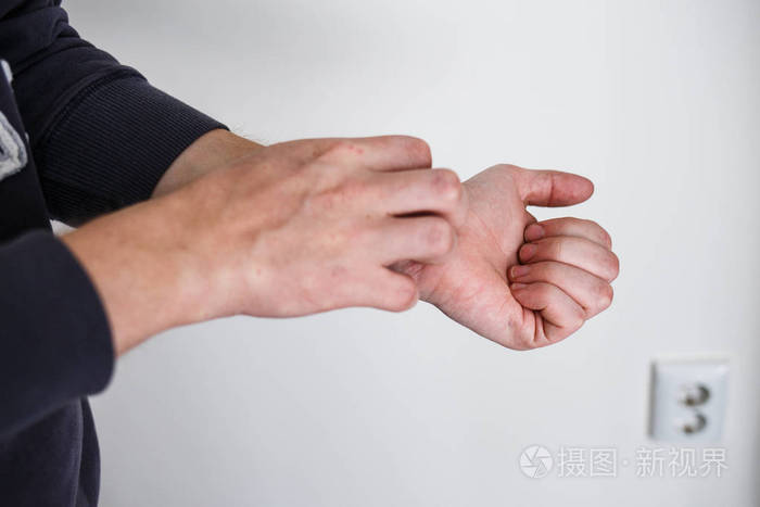 特写男人骚痒和用手抓挠.银屑病或湿疹手上.特应性过敏皮肤红斑