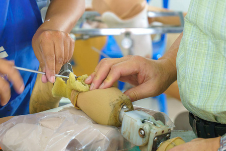 医疗技师为截肢患者制作新的铝制假肢腿