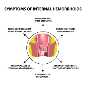 内痔疮症状。直肠中的痔淋巴结, 。图表.独立背景上的矢量插图