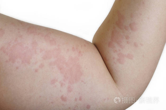 过敏引起的过敏皮疹