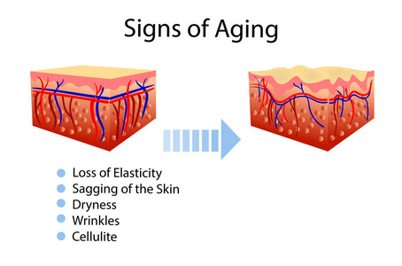 有老化迹象的向量图, 两种皮肤, 用于美容和医疗保健插图
