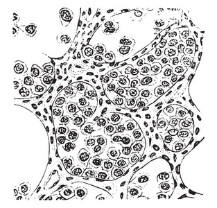 牙槽肉瘤, 复古刻插图