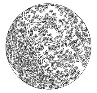 部分肝脏癌, 葡萄酒雕刻插图