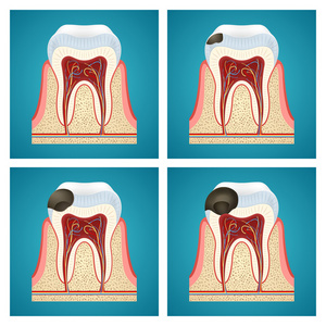 阶段的进步对人类的牙齿龋图片