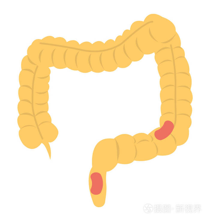 大肠肿瘤的小肠炎症