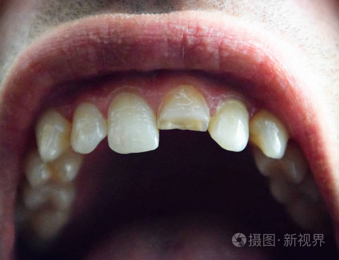 牙齿断了在一个男人嘴里断了上切牙.男子向牙医展示口腔.断牙的治疗