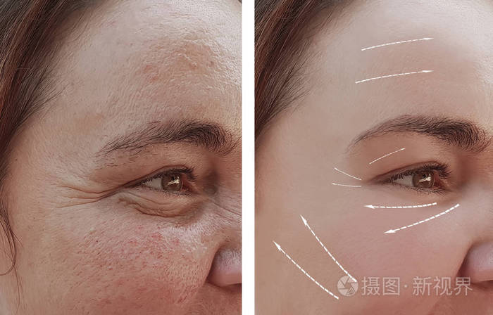脸上的女人脸上的皱纹在手术前后箭