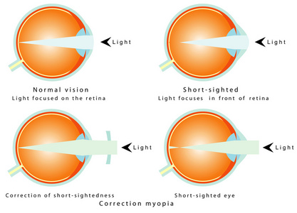 近视