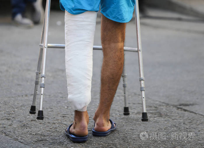 细节的腿在石膏铸造病人去医院的帮助下的金属框架