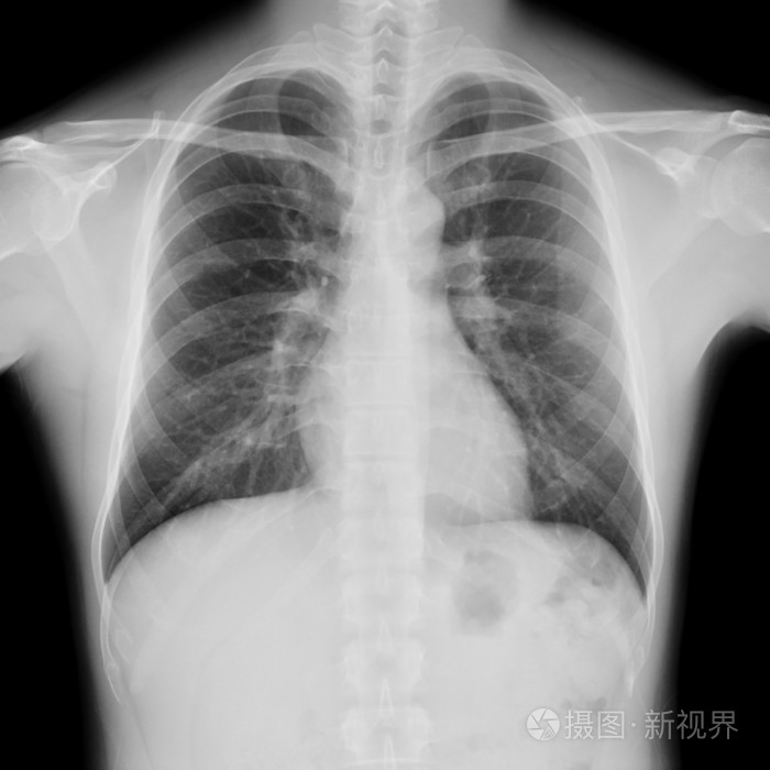 正常男性胸部 x 线片照片-正版商用图片09eszb-摄图新视界