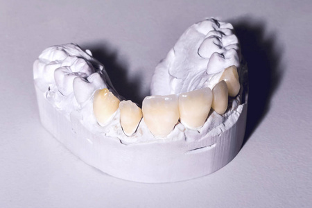 表上牙科石膏模型照片