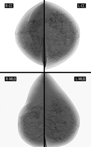 乳腺放射成像.右乳房手术。纤维 化。负