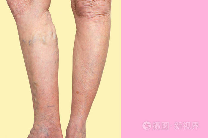 在女性的腿上静脉曲张