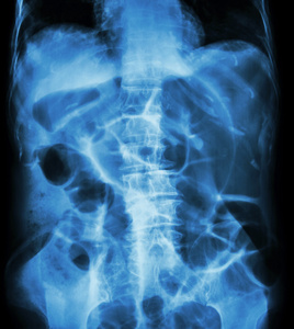 肠梗阻 x 射线腹部仰卧 大肠癌