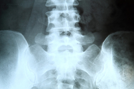 骨盆和脊柱的 x 射线