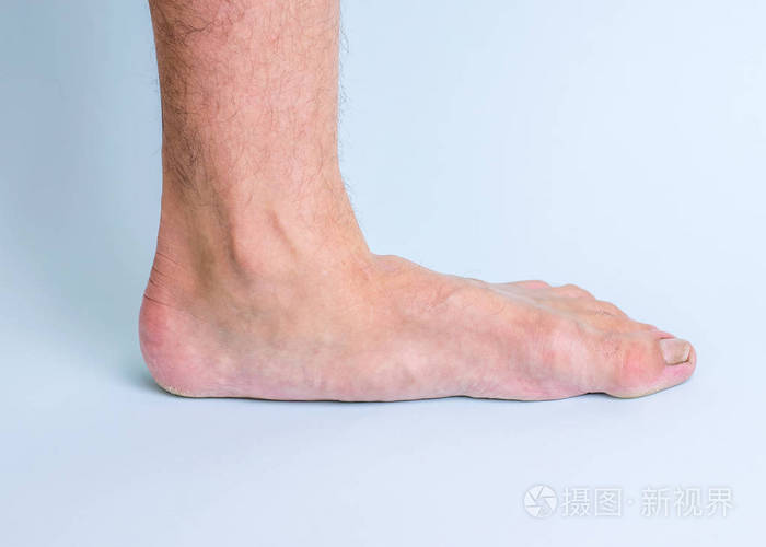 照片 有关节疾病和扁平脚症状的人的左腿.腿部和关节疾病.jpg