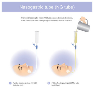 通过插入 ng 管的液体喂养通过鼻子, 下喉咙和食道, 并在胃结束。插图图形