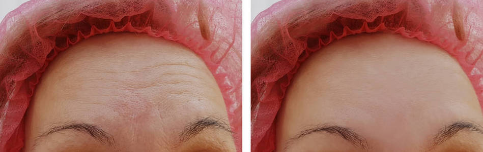 面部妇女皱纹前和后美容抗衰老程序