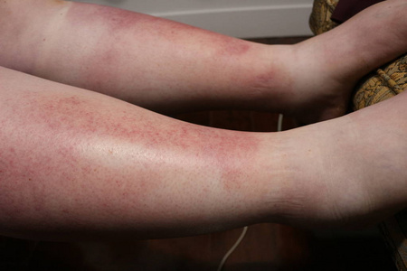 可怕的太阳烧伤女性腿, 已导致太阳中毒