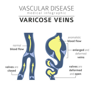 血管疾病。静脉曲张症状, 治疗图标设置。医疗图表设计。矢量插图