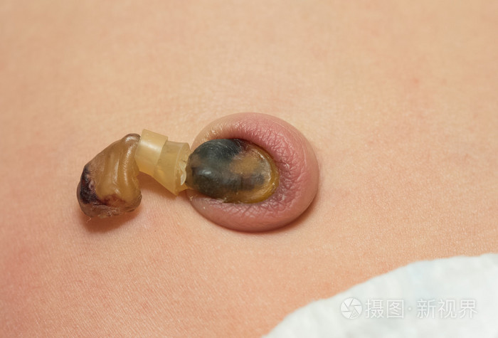 干一个新生的婴儿腹部脐带残端照片-正版商用图片0b6ft4-摄图新视界
