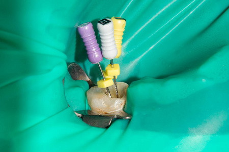 特写治疗人牙在牙填装腐烂的诊所。使用橡胶坝密封系统和分期的清洗和运河