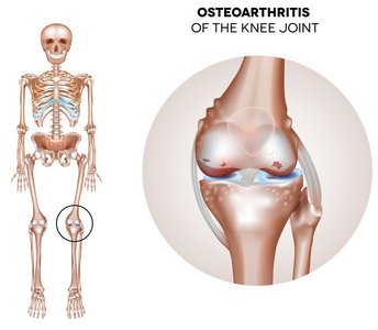 膝关节炎