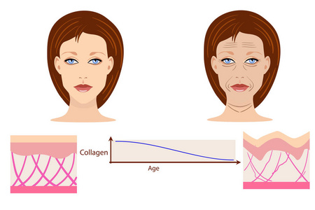 矢量的脸和两个类型的皮肤岁和年轻人为医疗和美容的插图