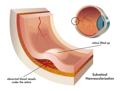 视网膜下新生血管计划