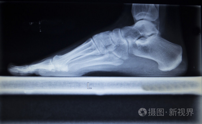 脚伤承载重量x线骨科扫描