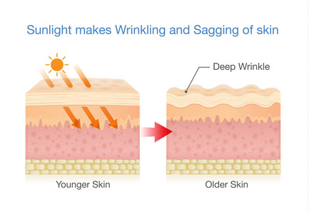 阳光使皮肤松弛
