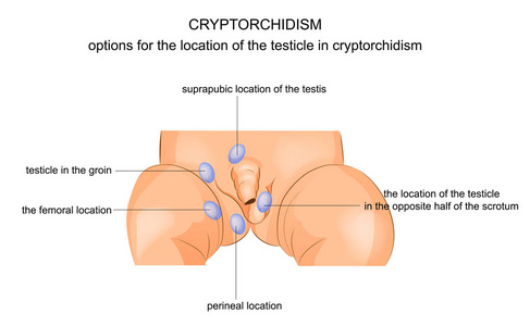 隐睾。睾丸的位置选项