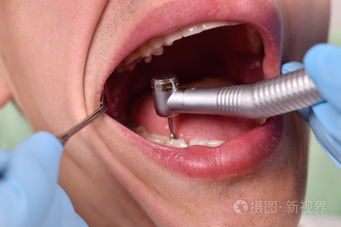 牙医用钻