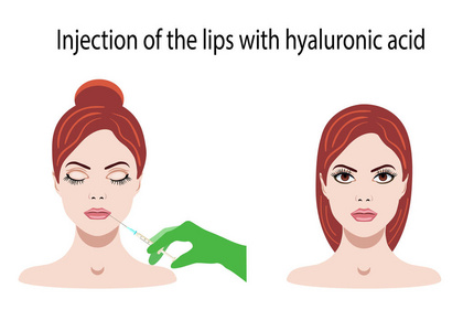 白色背景下唇注射用透明质酸的矢量图解