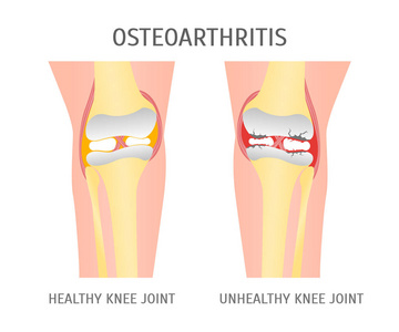 卡通骨关节炎健康和不健康的膝盖。矢量