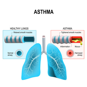 哮喘。人类的和支气管