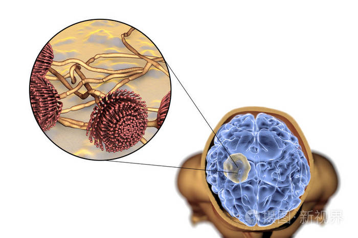 曲菌球病的真菌曲霉大脑和特写视图